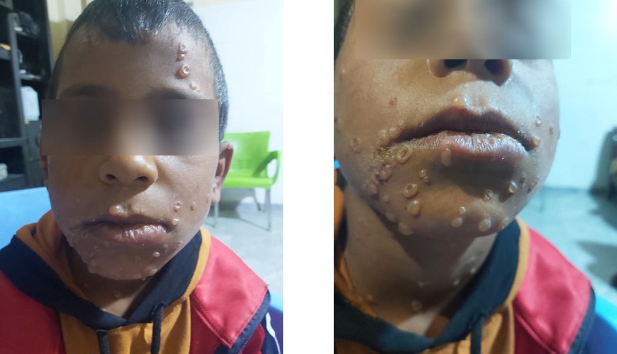 هل اكتُشفت أول إصابة بـ"جدري القردة" في شمال غربي سوريا؟